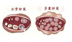 试管婴儿多囊卵巢综合症是什么？
