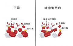 试管婴儿可以避免地中海贫血吗？