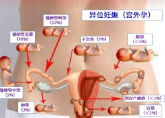 试管婴儿宫外孕多久能发现