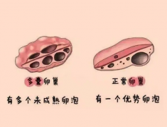 试管婴儿多囊激素高